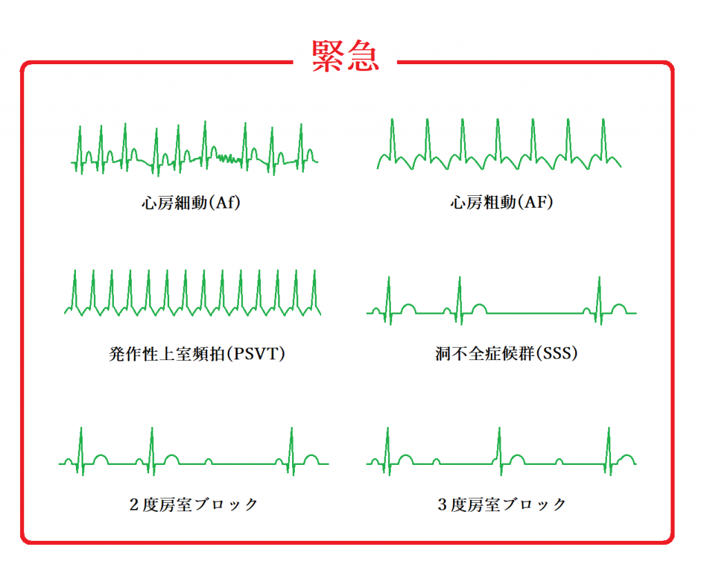 動悸、頻脈、不整脈とは何かを理解する